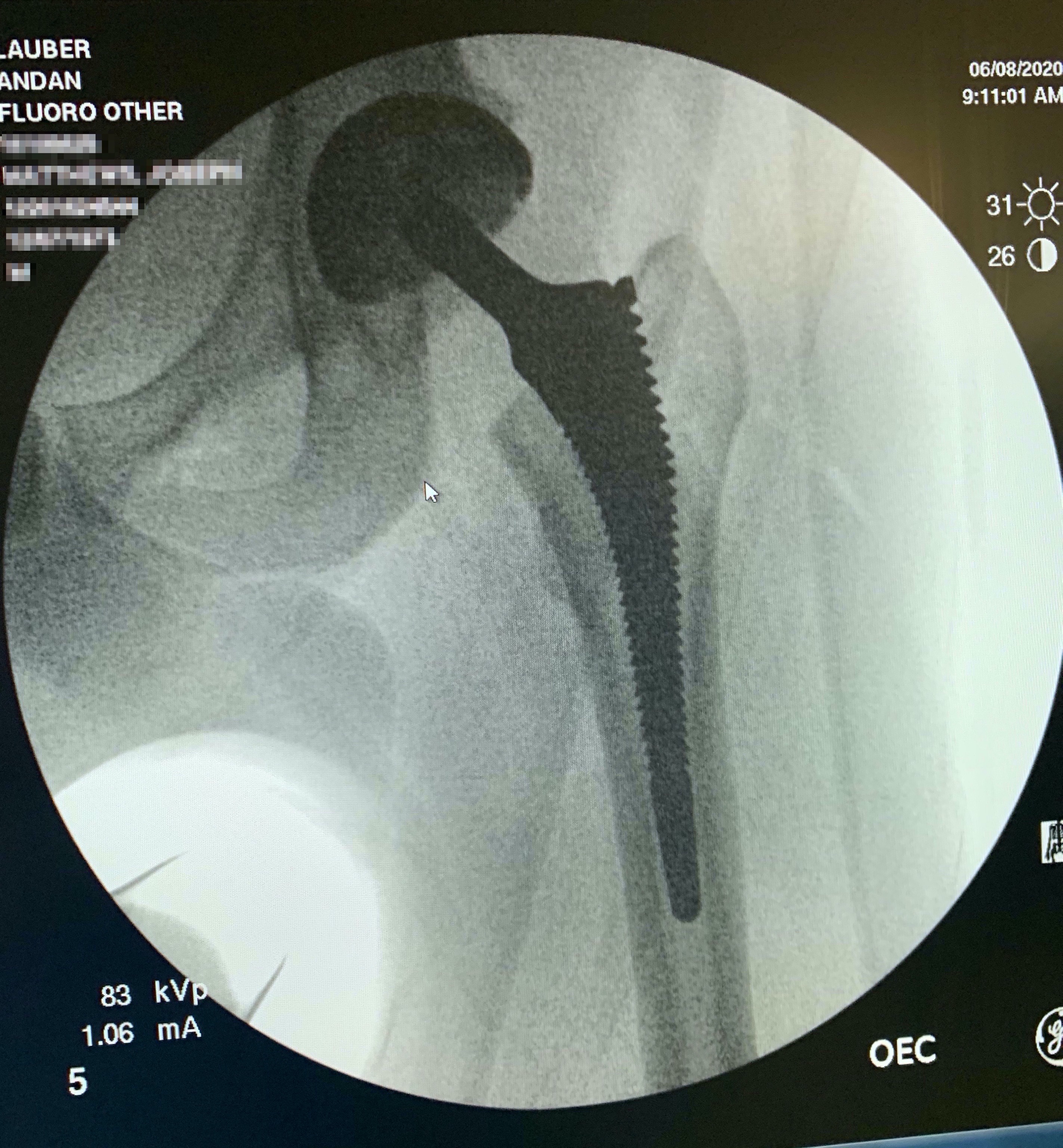 X-ray image of a total joint replacement of the hip showing implanted hardware