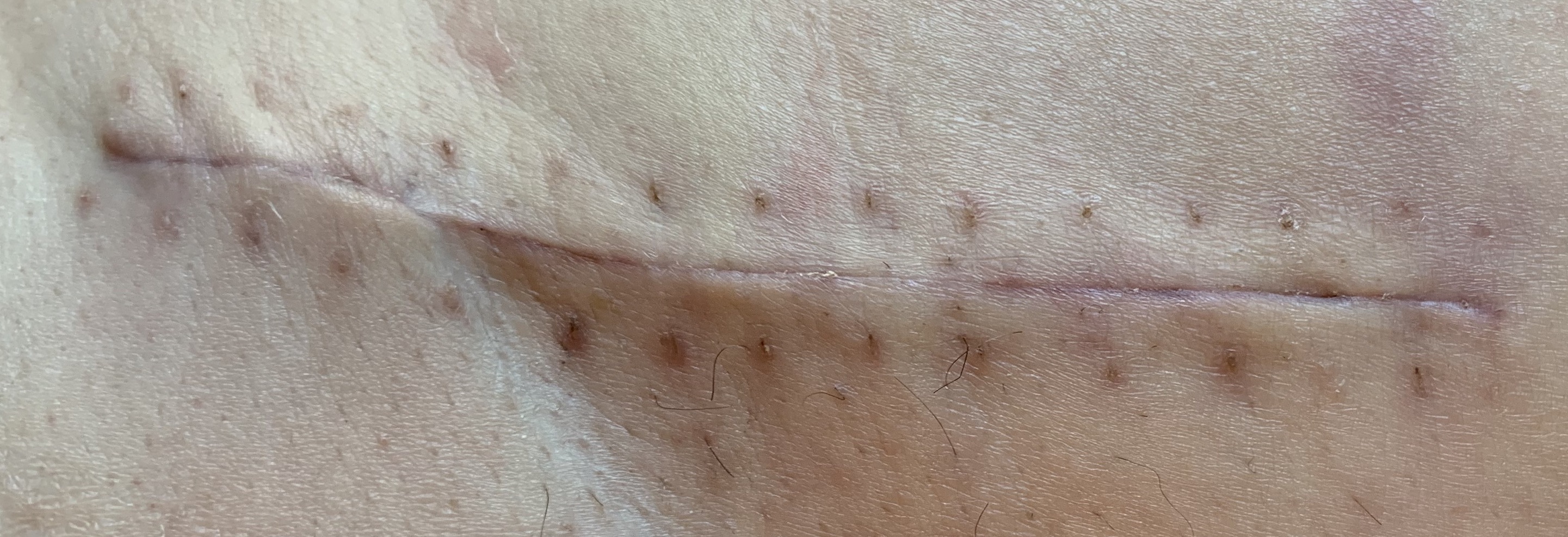 close up of a scar in caucasian skin