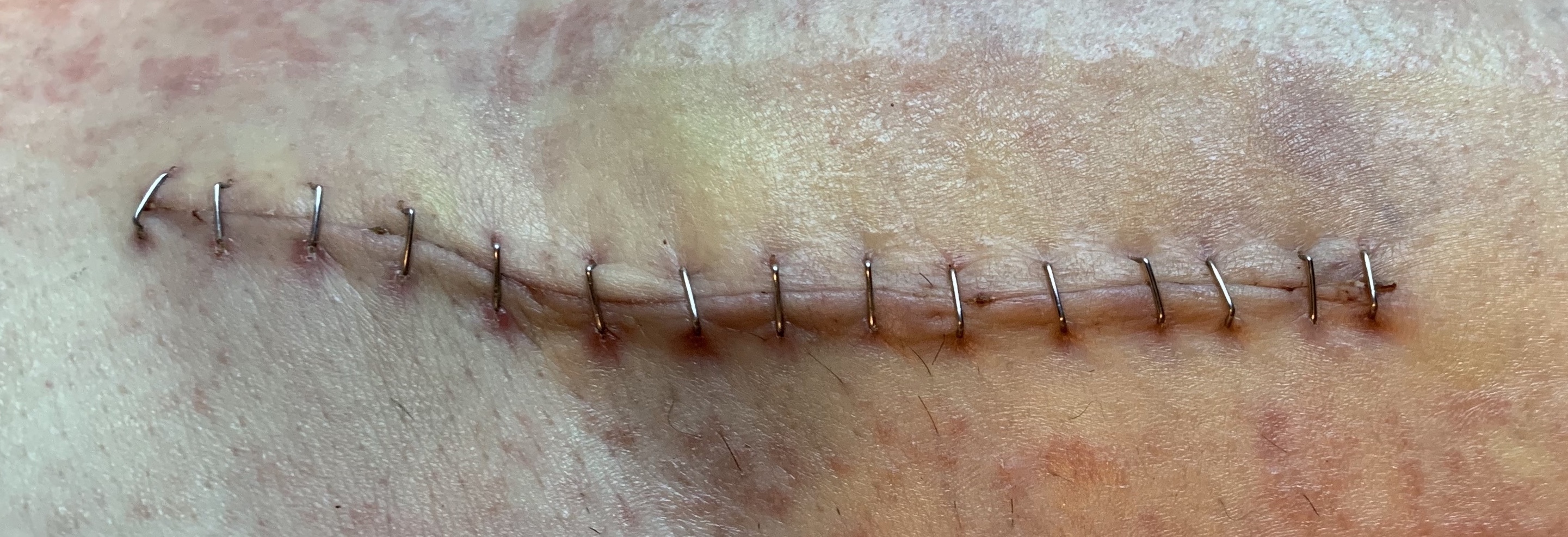 closeup of medical staples closing an incision in caucasian skin