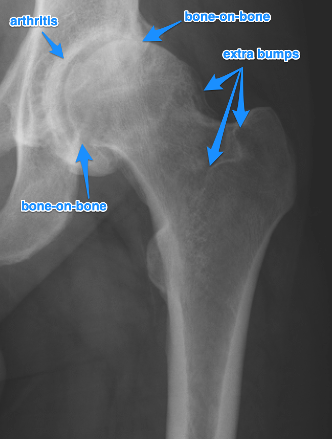 marked up X-ray showing hip arthritis