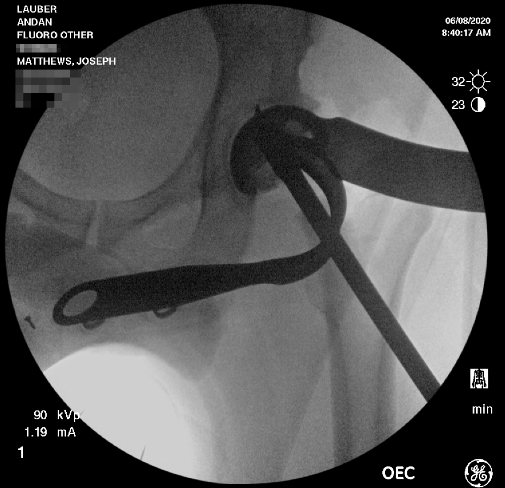 X-ray of medical implant procedure total hip replacement