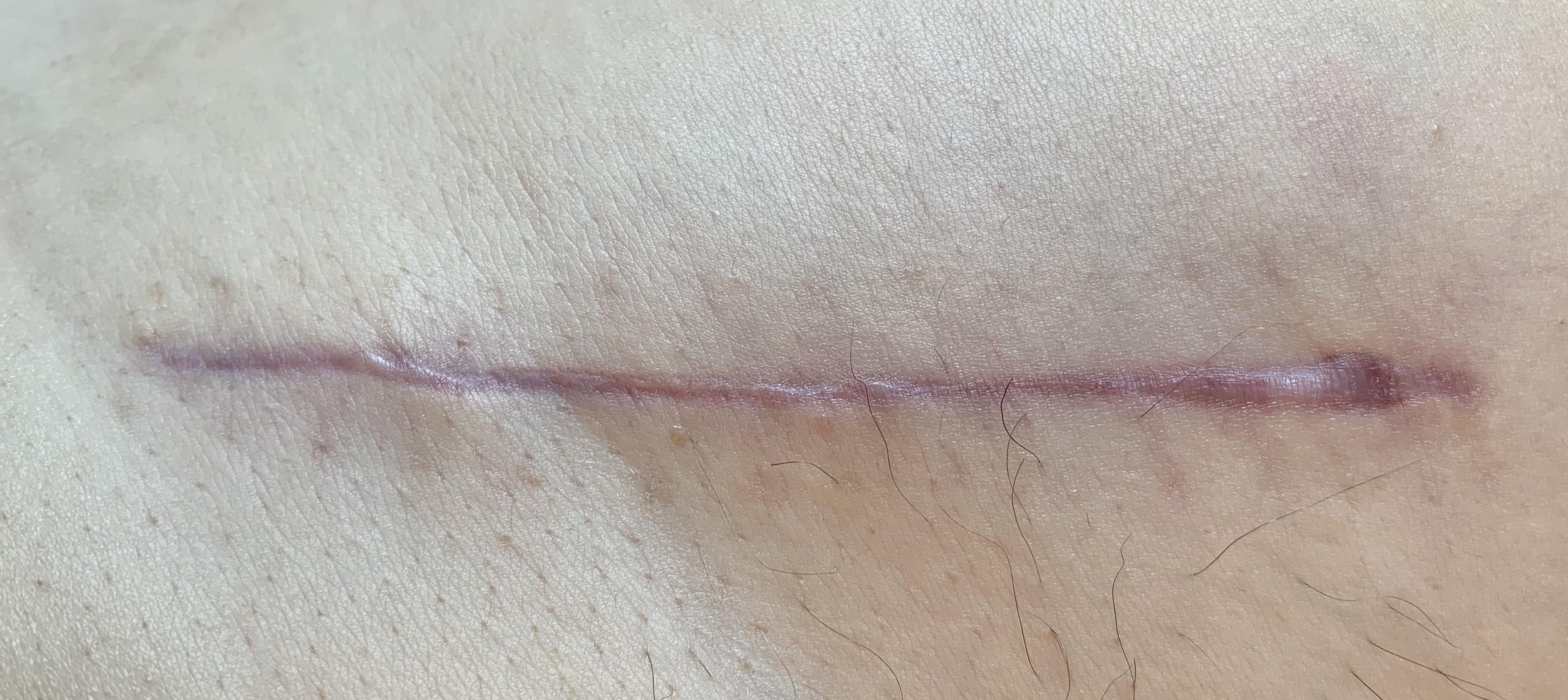 photo of a healed DAA hip replacement scar